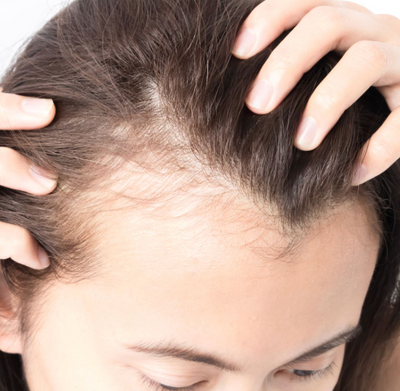 Increased Hair Shedding & Fiber Breakage
