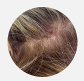 Scalp Dryness & Inflammation